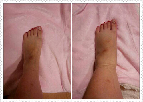 浮腫治療前と後の写真